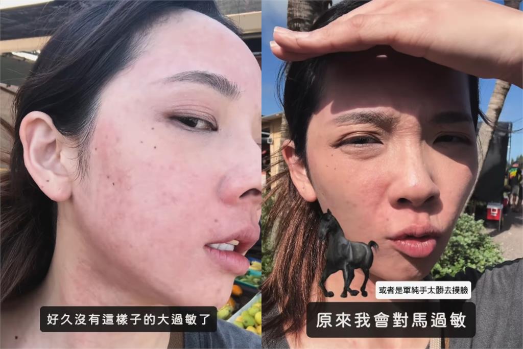 滴妹飛夏威夷做「1件事」大過敏!紅疹爬滿身「近距離爛臉照」嚇壞眾人