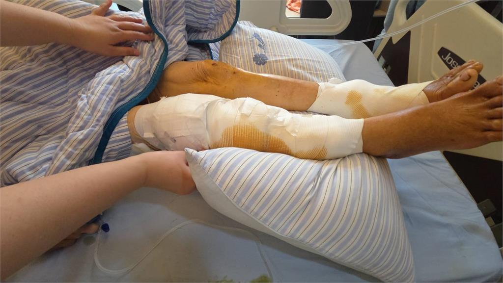 彰化埤頭驚傳惡犬咬人　老婦慘遭群攻200多處傷