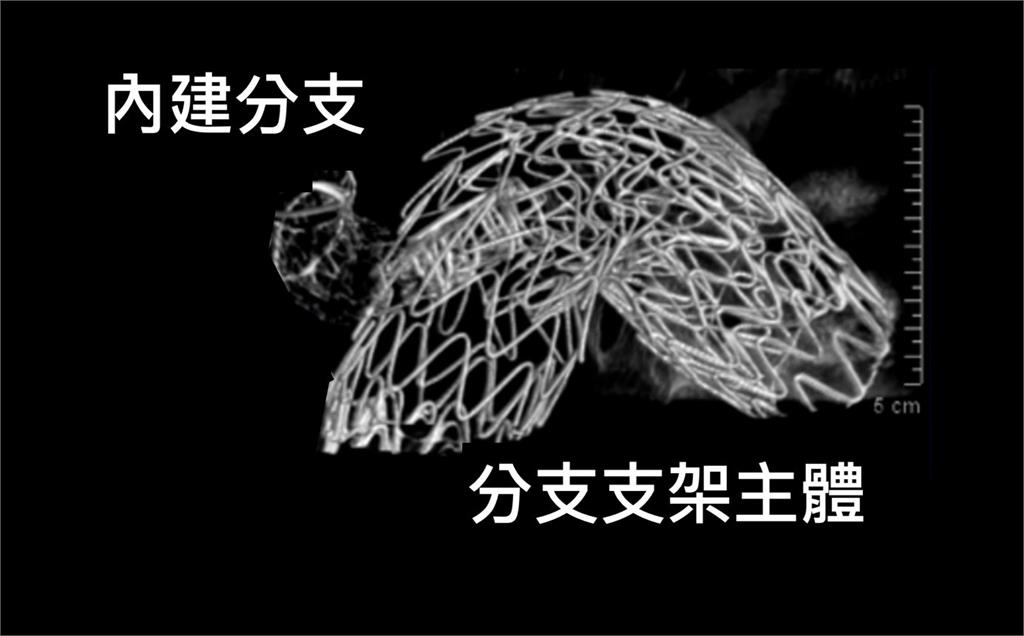 不開胸、心臟不停跳完成手術治療 林口長庚引領微創主動脈分支支架手術新紀元