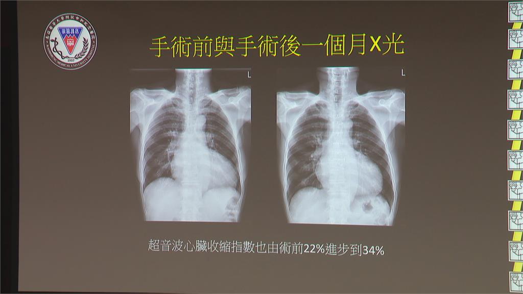 67歲男心臟先天少一瓣膜突昏倒 術後順利出院胖了五公斤