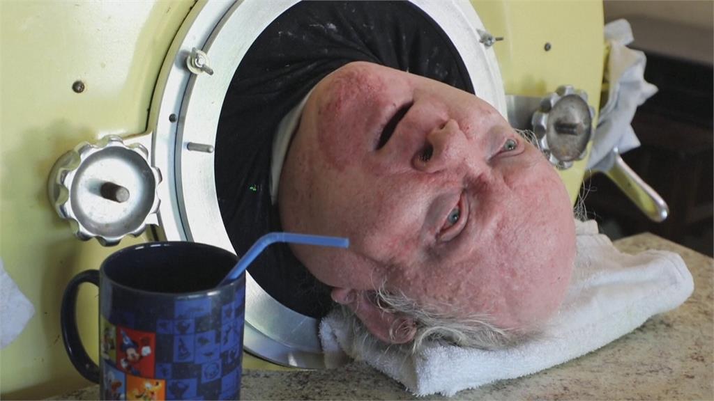 美國「鐵肺人」78歲離世　鐵肺生活達70多年　創世界紀錄