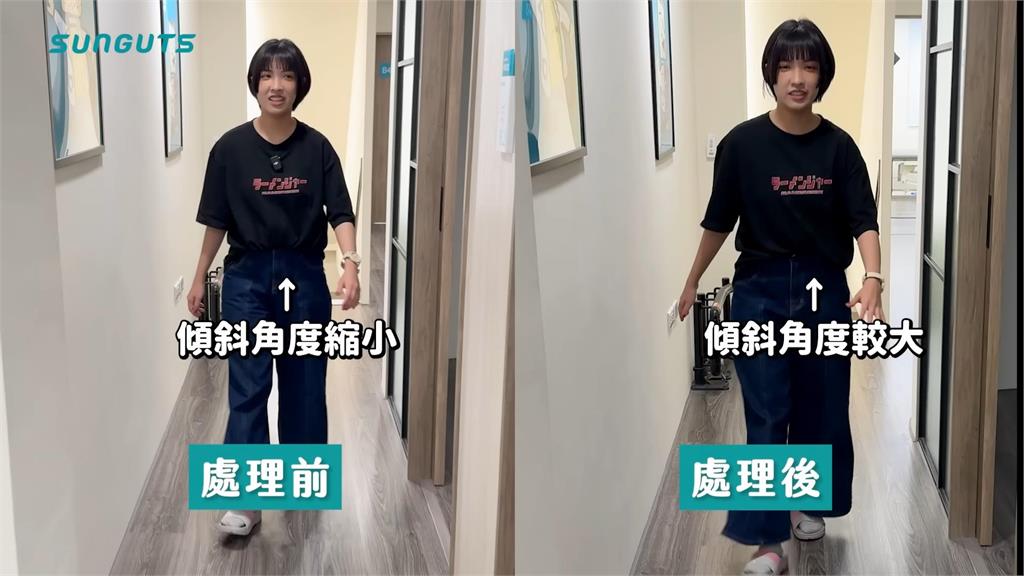 從樓梯上摔下來?!找物理治療師解決問題 點出:撞擊點在腰部導致不對稱