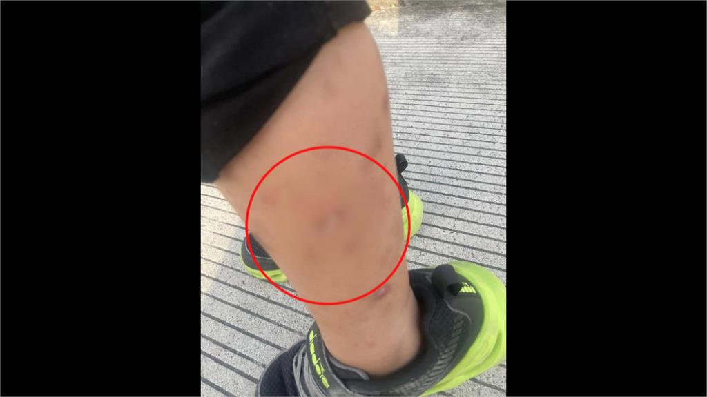 大都會公園暗藏危機! 男童遭3公分鐵釘刺傷送醫