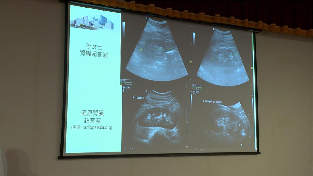 腎絲球過濾率僅8分 女子「中西醫合療」擺脫洗腎人生