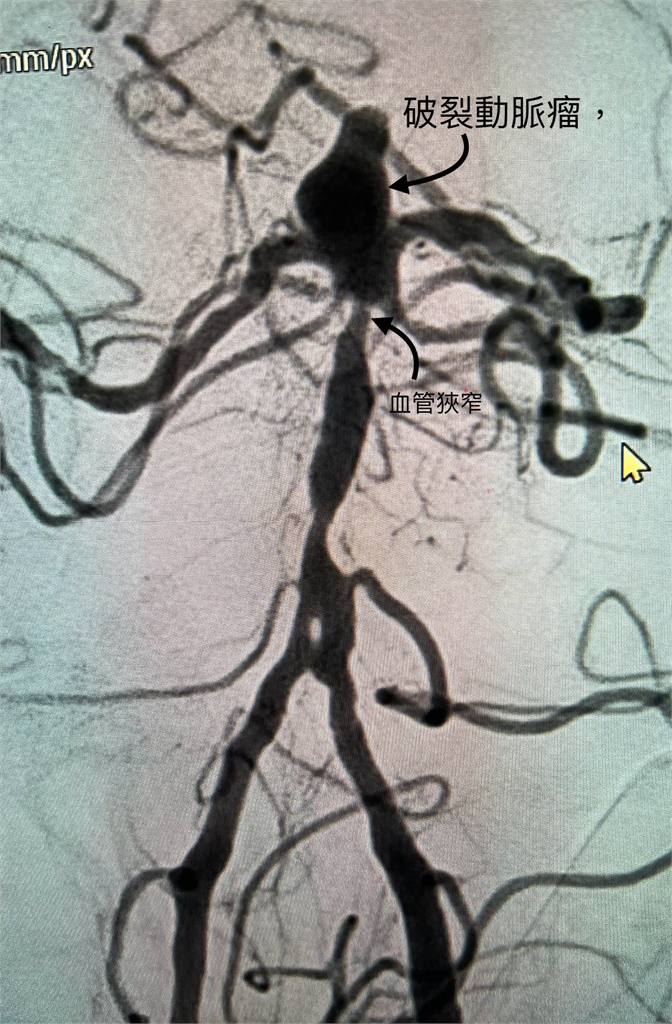 天冷血管急速收縮易釀「動脈瘤」爆裂　醫示警：1/3恐當場死亡