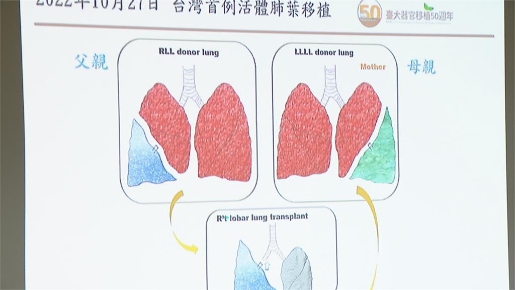 全台首例活體肺葉移植！　父母「各捐一半肺」救愛女