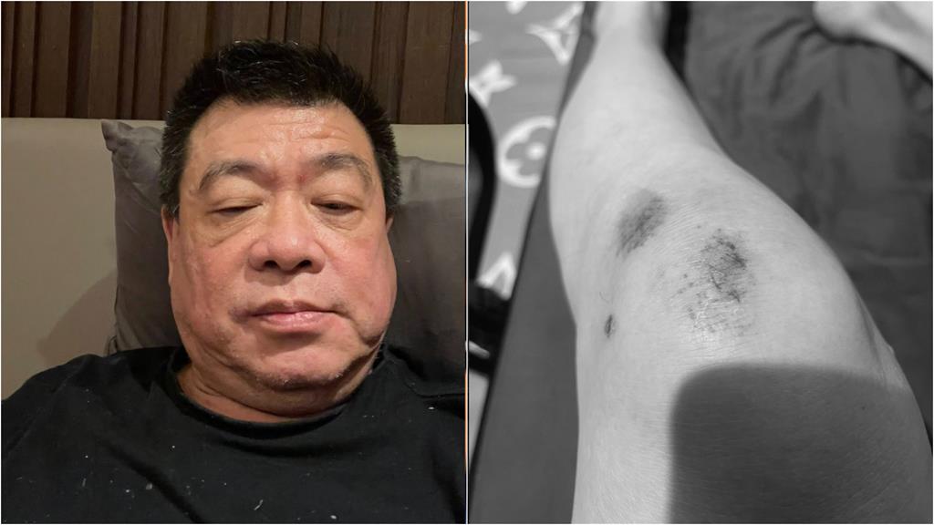 幫于朦朧發聲收死亡威脅 孫德榮突曬傷勢照曝「4天摔3次」:再跌恐上西天!