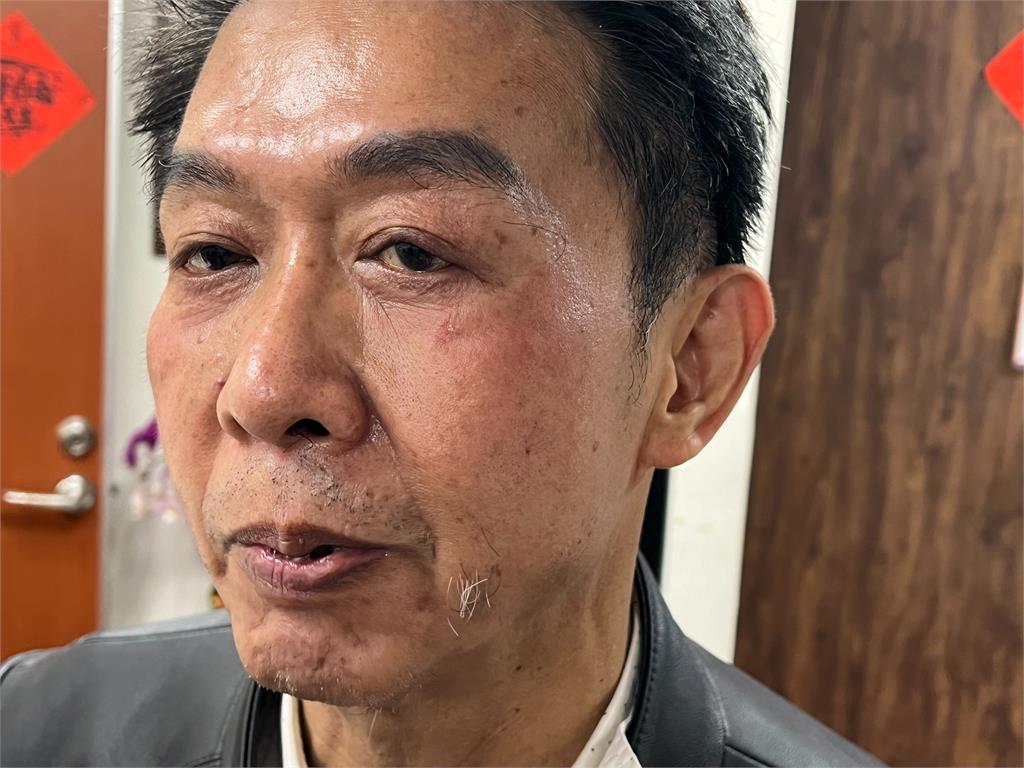 快新聞/傷勢曝光!選罷法肉搏戰 許智傑控遭邱鎮軍「壓頭4次」