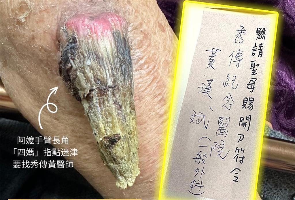 媽祖唯一指定醫師!阿嫲手臂長巨角…「仙界轉診單」指示她找彰化仁醫