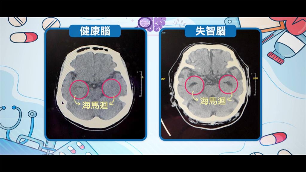 異言堂/名醫教延緩失智 四大黃金守則