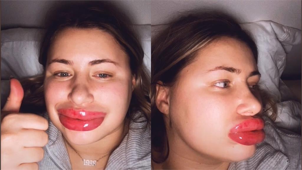 豐唇手術出意外！她雙唇腫8倍變「香腸嘴」2天無法說話、進食險奪命