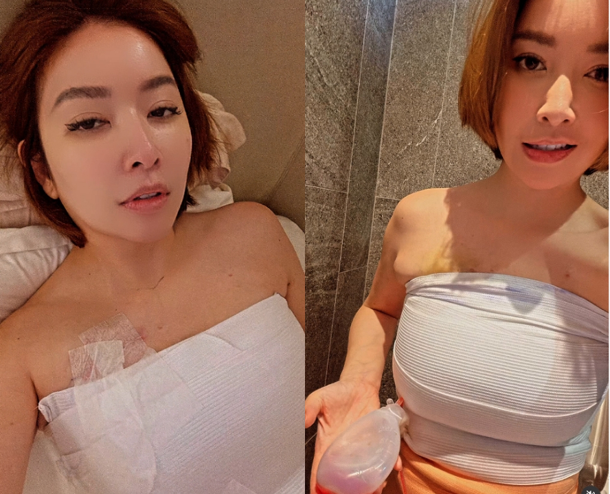 許維恩PO片「切除雙乳」抗乳癌過程！突喊「7月又要衝一波」網湧入關心