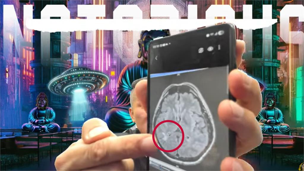館長直播曬X光片自曝「腦有問題」!這1部分消失「驚見白色塊狀物」險癱瘓