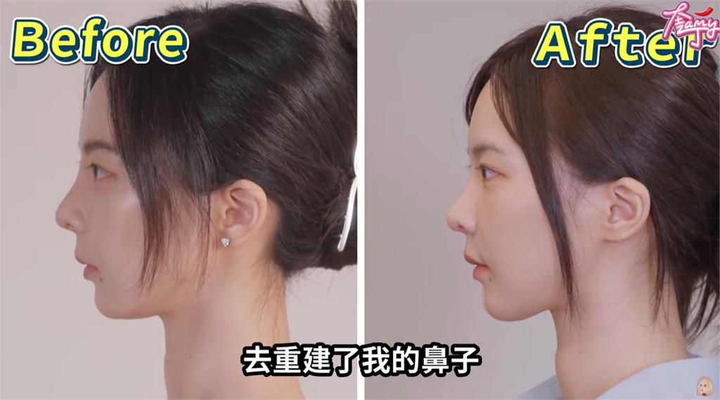 奎丁臉遭細菌入侵「整張臉腫到變形+眼下巨大水泡」!坦言:我覺得毀了