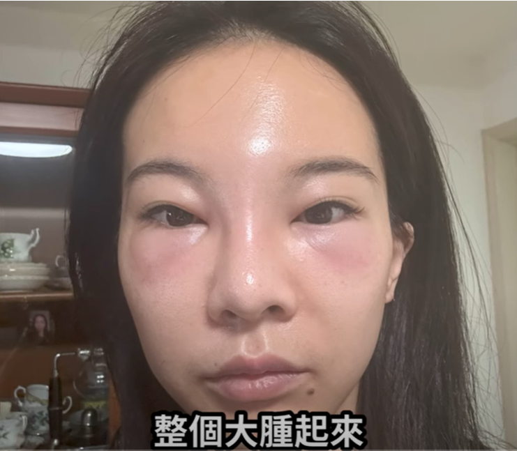 奎丁臉遭細菌入侵「整張臉腫到變形+眼下巨大水泡」!坦言:我覺得毀了
