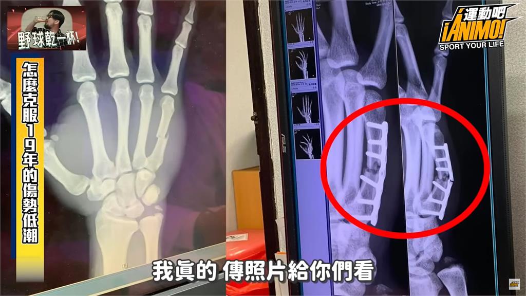 12強賽(影)/陳傑憲回憶生涯首度動刀 台灣隊長復健太凶竟把「鋼板折斷」