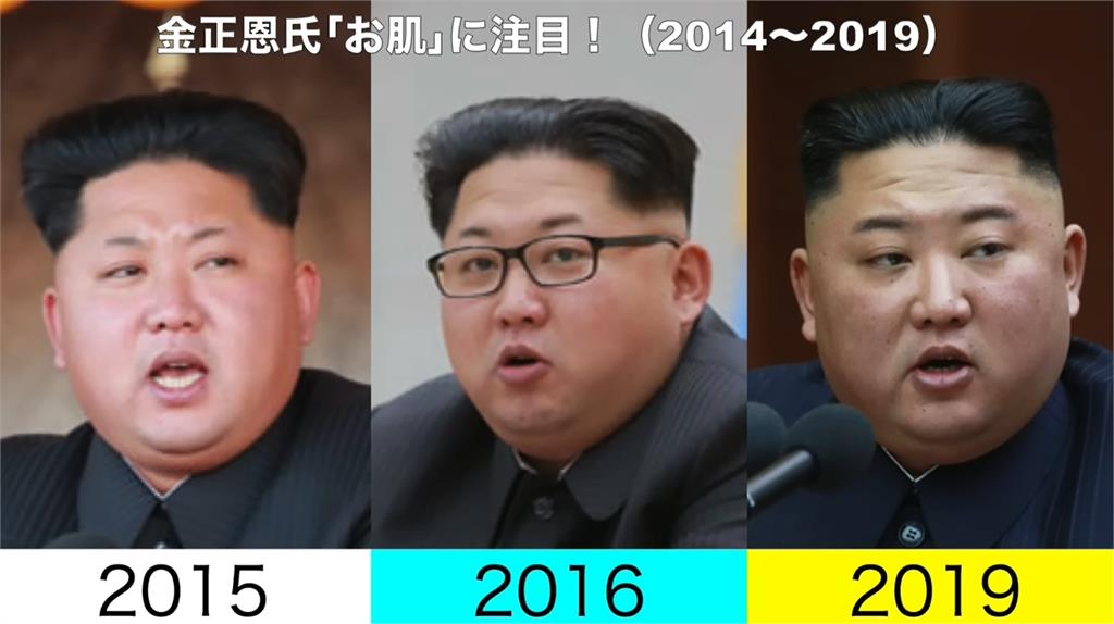 金正恩「無修圖照」爆健康疑雲!臉上長滿「詭異肉芽」10年前對比照曝光