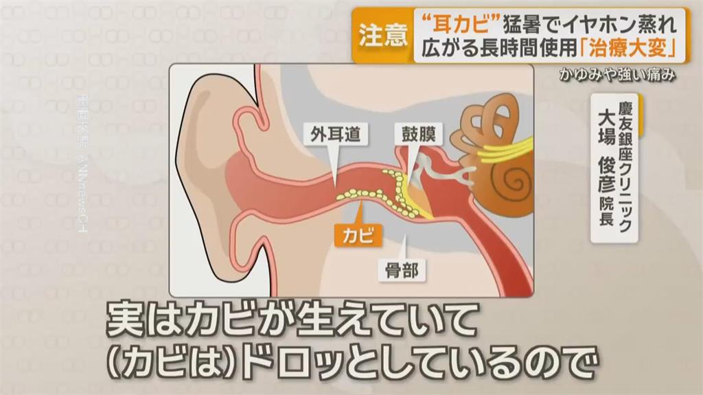 注意！ 長時間戴耳機　恐引發「耳黴菌」症狀