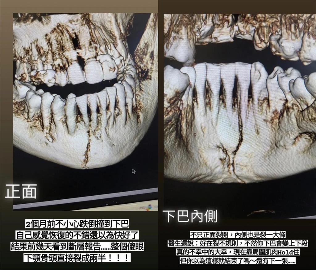 豬哥亮愛女遛狗重摔「下顎骨斷兩半」！醫曝最慘後果：下巴會變上下段