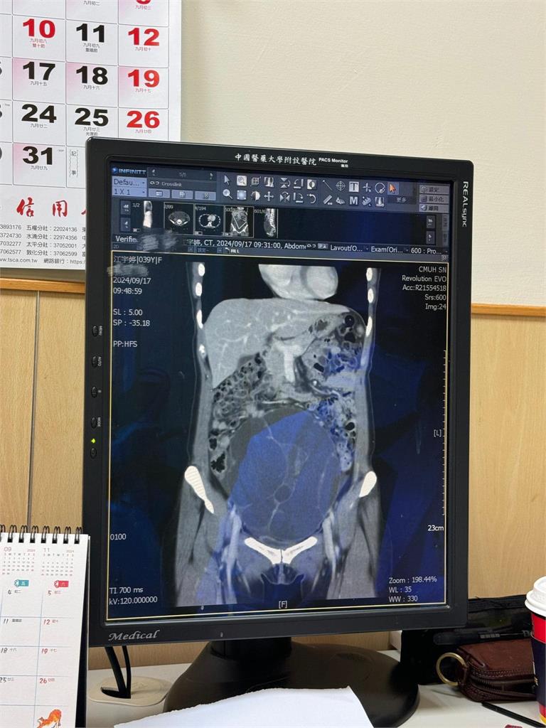 網紅江老師突曝「子宮長19公分腫瘤」急開刀化驗！淚曝最慘恐拿掉子宮