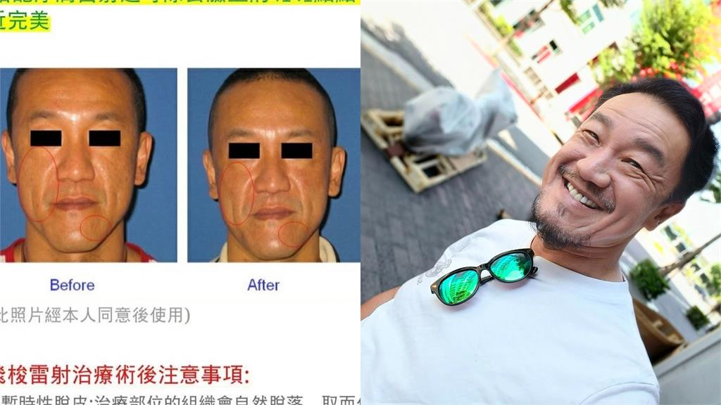 醫美模特「對比照外流」竟是陳為民！「打碼無效」秒被認出網笑：2張都before？