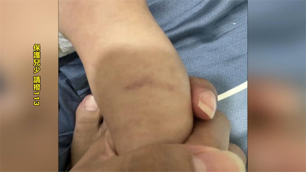 悚！家長信任保母護理師背景　男嬰疑卻遭不當對待滿身傷