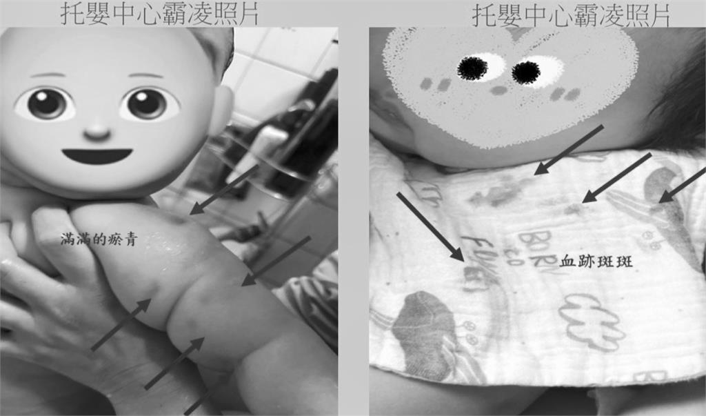 嘉義某托嬰中心爆虐童！　幼兒手臂瘀青、「口水巾留血跡」