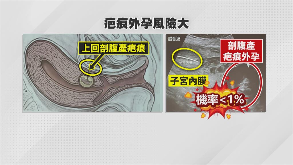 恐致子宮大出血! 台大團隊冒險協助「剖腹產疤痕外孕」順利生產