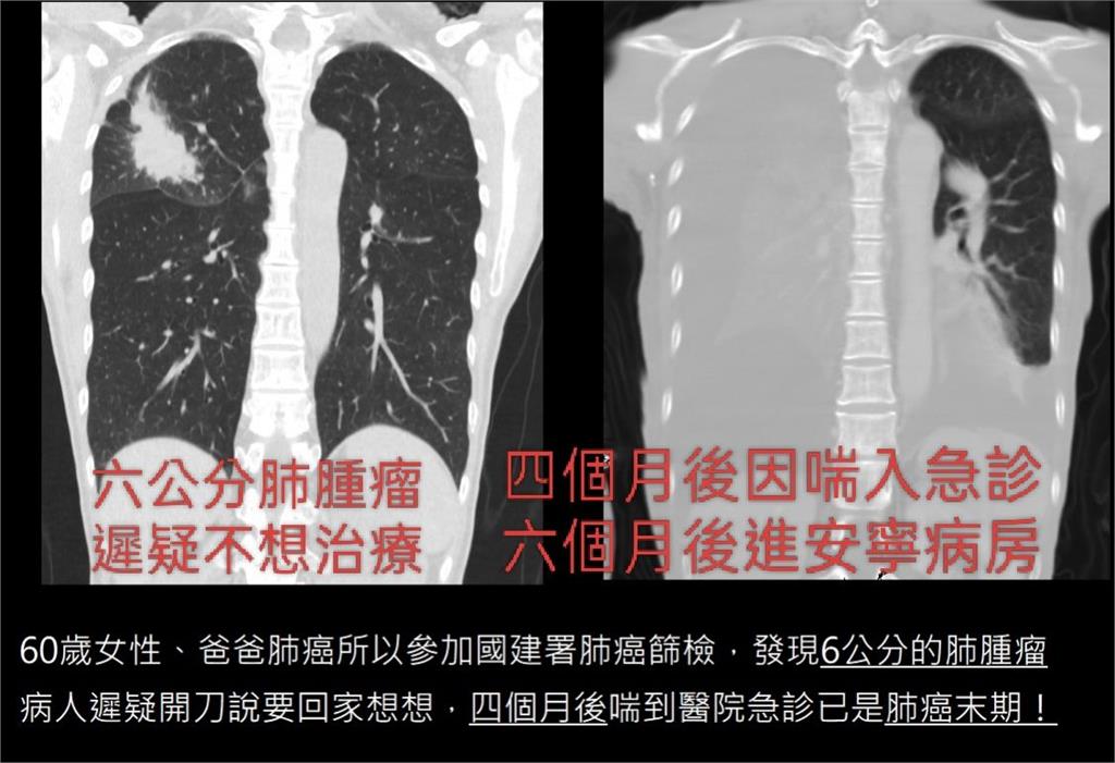 60歲老婦查出6公分肺腫瘤「回家想想」！4個月後右肺消失...慘變肺癌末期