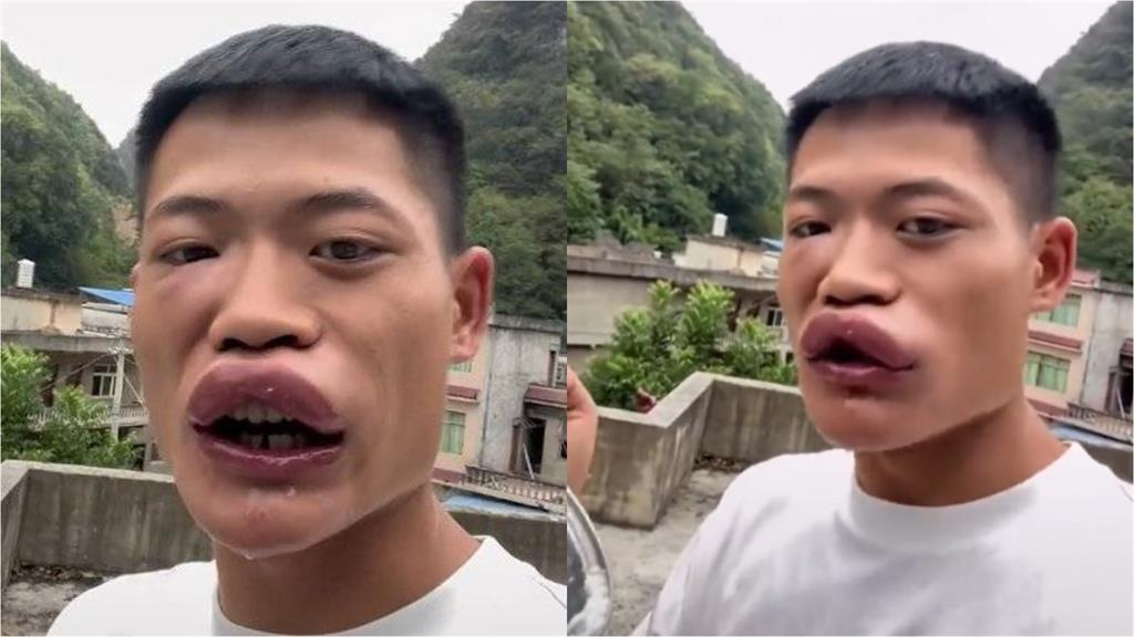 中國網紅為衝流量生吞「2隻活蜜蜂」!腫成香腸嘴急送醫下場曝光