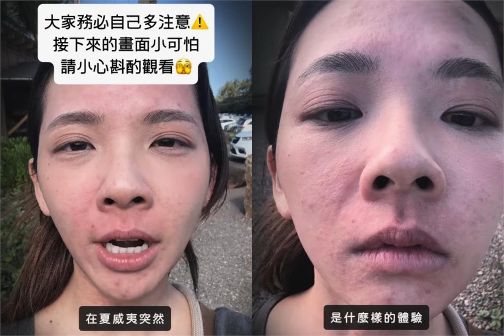 滴妹飛夏威夷做「1件事」大過敏!紅疹爬滿身「近距離爛臉照」嚇壞眾人