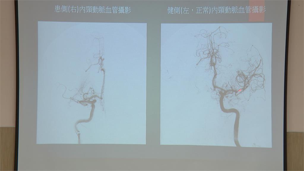 副所長執行外勤突「腦中風」 「內動脈取栓術」清除血栓搶救成功