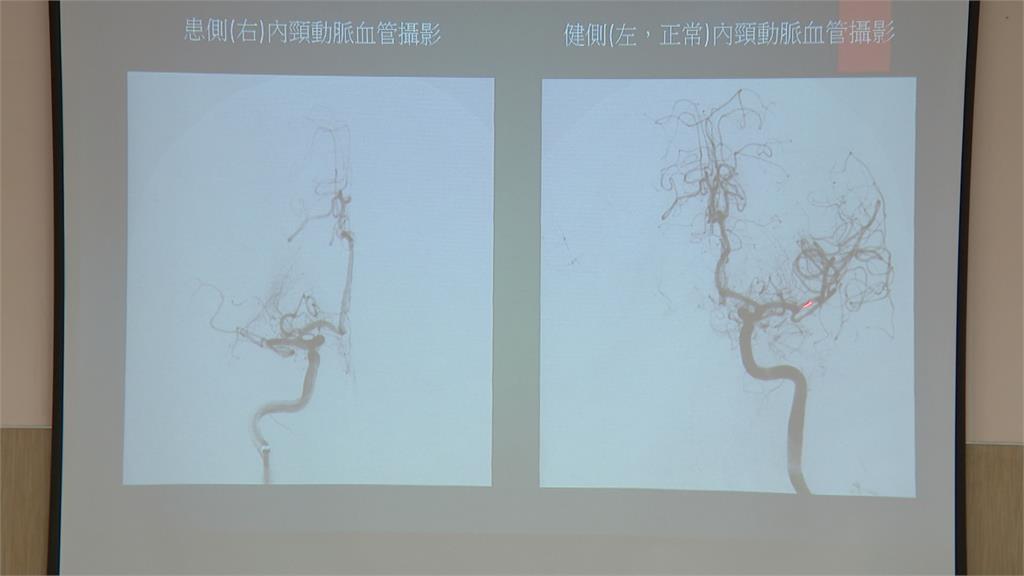 副所長執行外勤突「腦中風」　「內動脈取栓術」清除血栓搶救成功