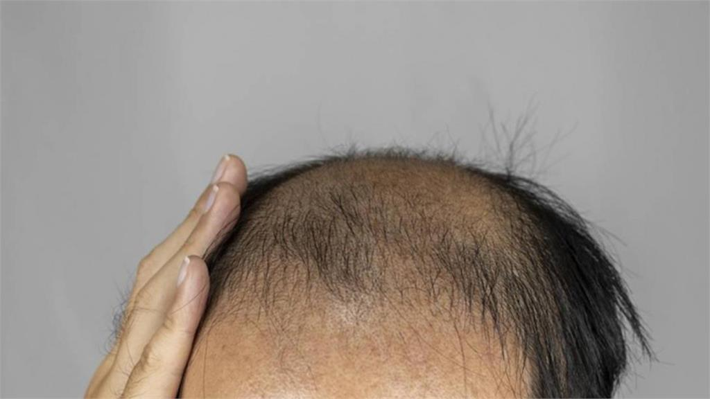 她為養生天天吃堅果竟害毛囊發炎狂掉髮？營養師示警：這類人吃錯最危險 