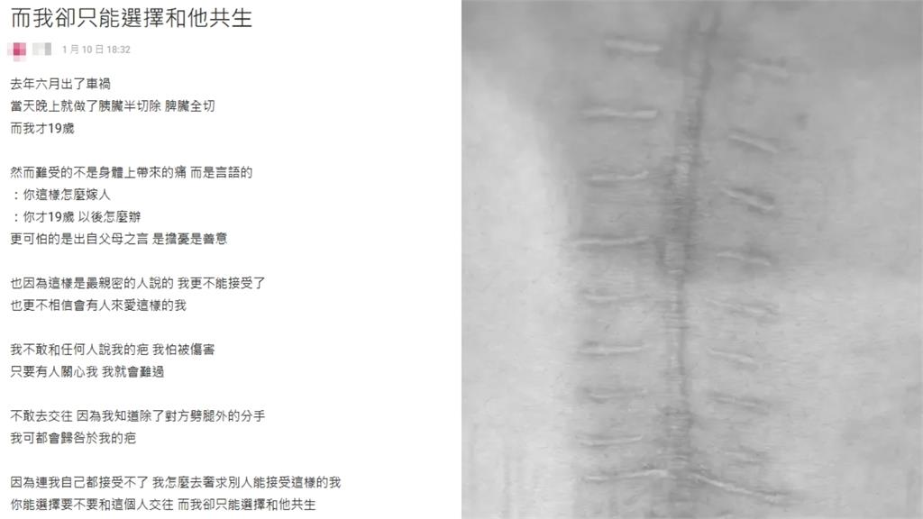19歲女車禍切了胰臟脾臟…竟被說「這樣怎麼嫁人」網鼻酸：健康就好