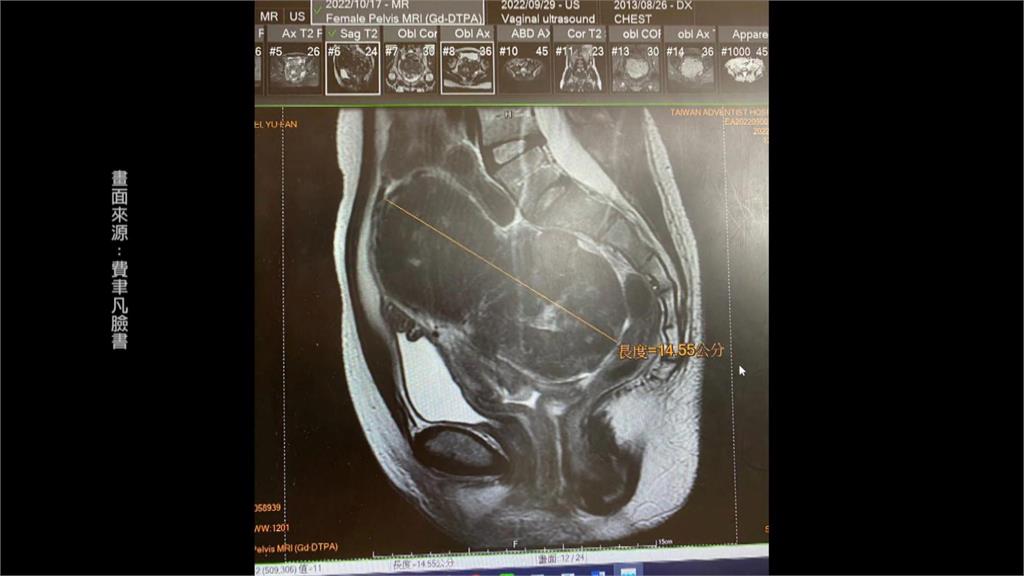 子宮肌瘤腫大連脊椎都歪斜　險危及鐵三選手費聿凡長運動生涯
