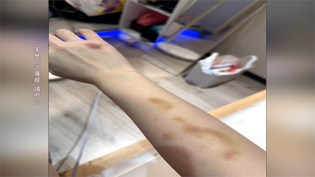 被前男友施暴憂成「信義女公關」命案翻版！　北市被害女子出面籲重視家暴