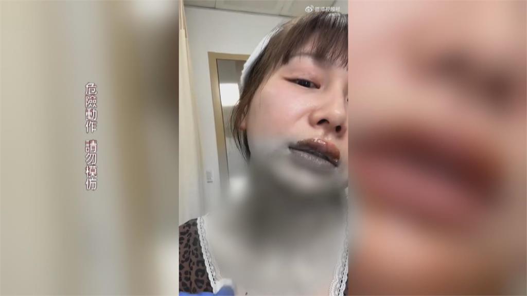 中國掀「噴火蛋糕」模仿潮　女星王添羽下巴、頸部遭燒傷