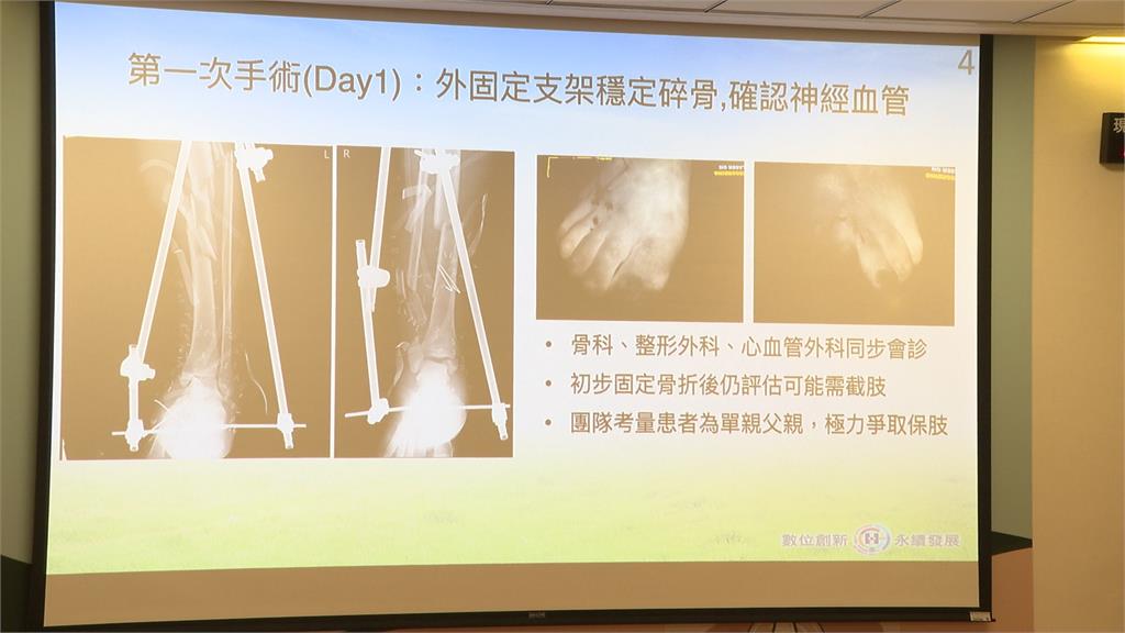 連環車禍雙側小腿"最嚴重骨折" 單親爸12次手術保住雙腳