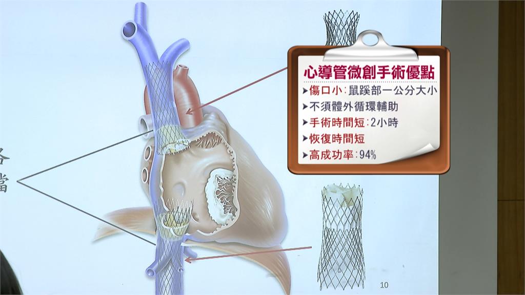 台大醫引進新醫材　心臟病患者術後還能打桌球！