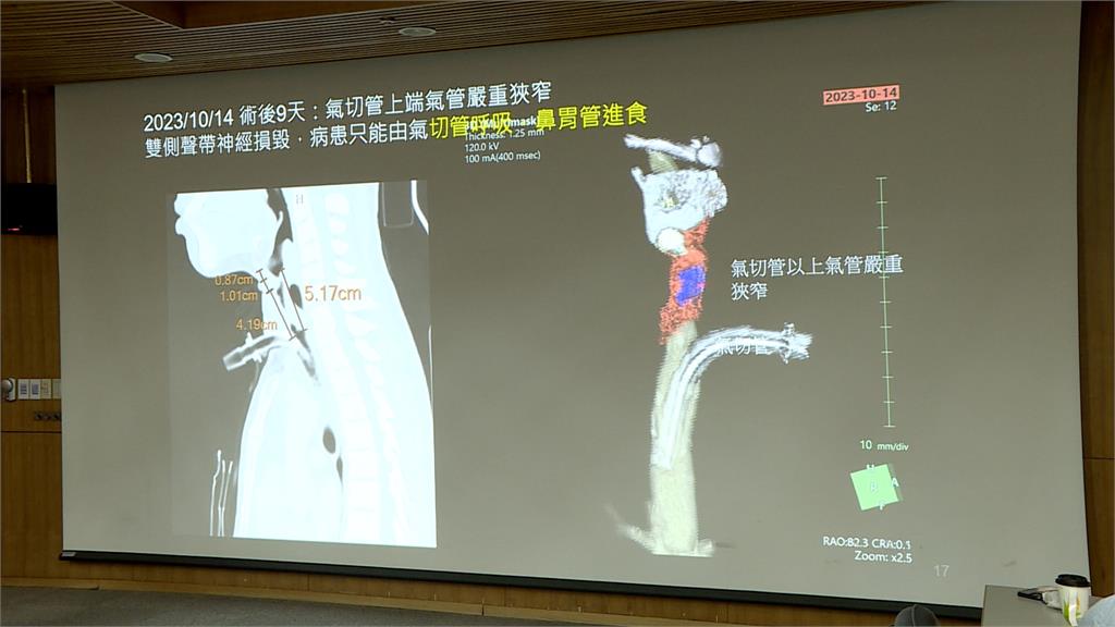 颱風天意外「電線繞脖」氣管破裂　台大植入主動脈修復氣管全球首例