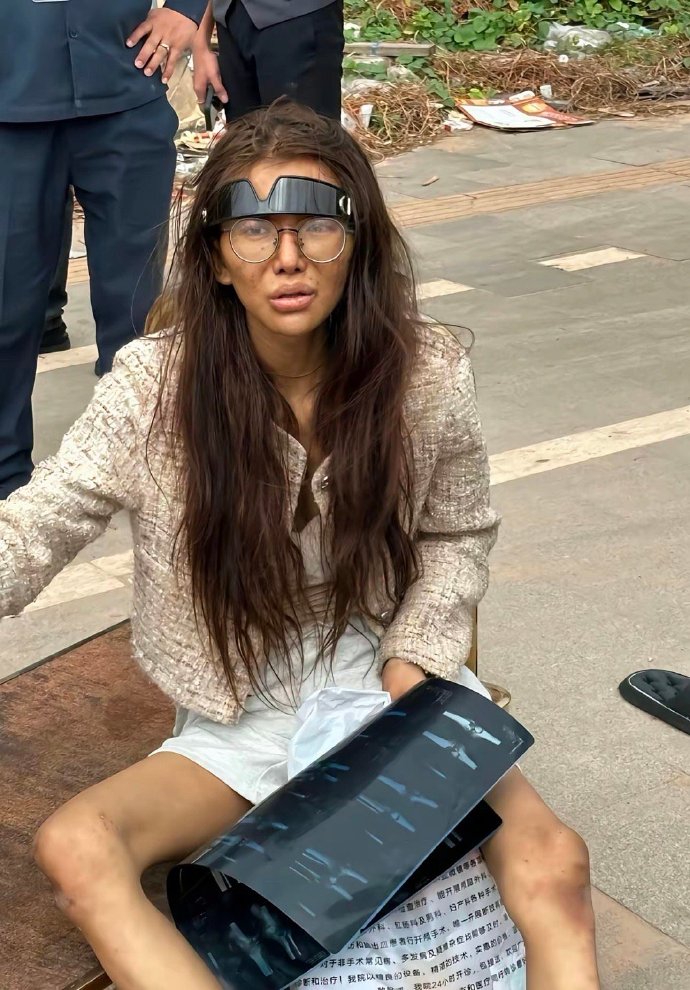 正妹網紅「被男友騙去柬埔寨」撈金！雙腿骨折流浪街頭「判若兩人」老父急哭