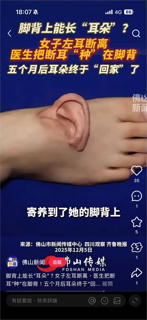 中國女工「左耳帶頭皮」被機器扯斷！耳朵奇蹟「寄生」腳背5個月後成功復位…