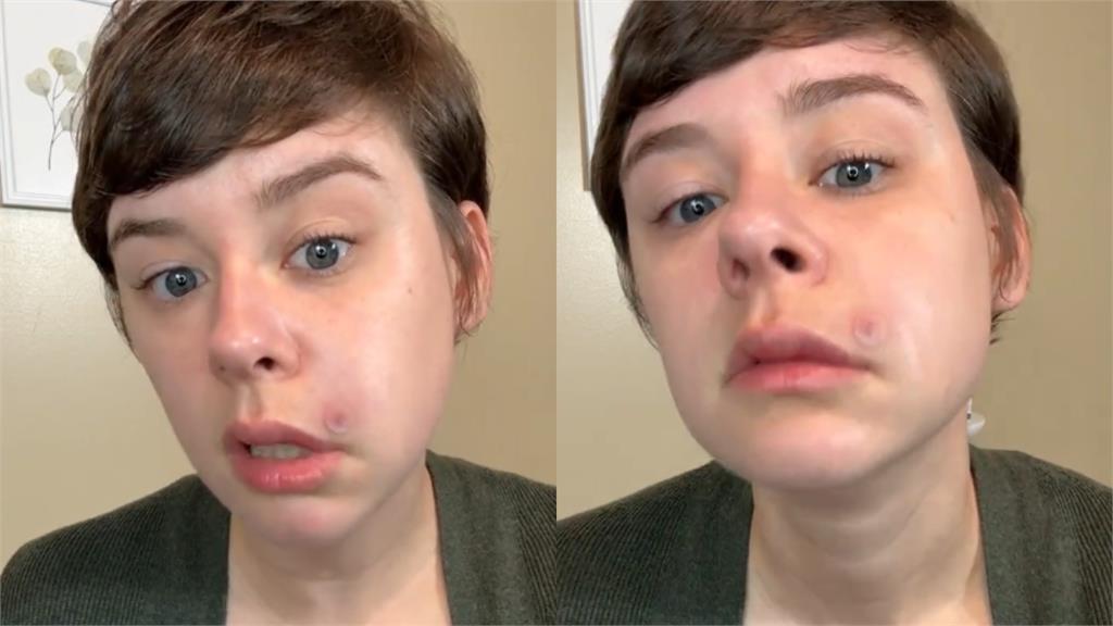 女網紅擠一顆痘痘竟「半臉癱瘓」！醫警告「這1處」最危險：死亡三角區