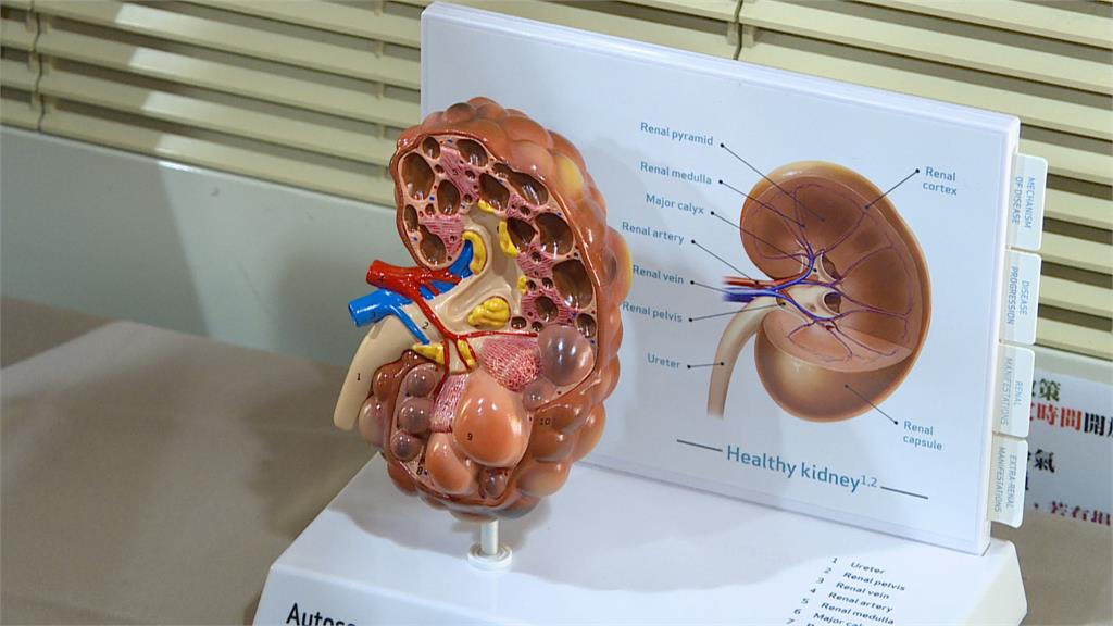 9萬多名洗腎病患2-3%罹「多囊腎」　患者九成皆遺傳