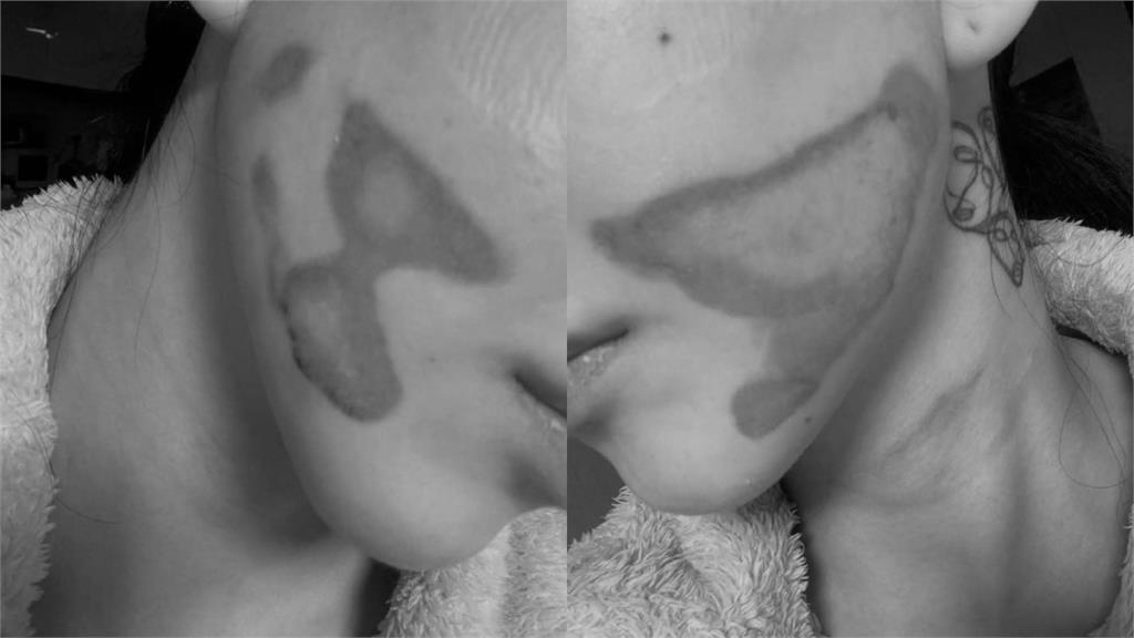 AOA前成員做「睡眠音波」驚傳二度燒傷！醫喊：舒眠麻醉恐成安全盲點