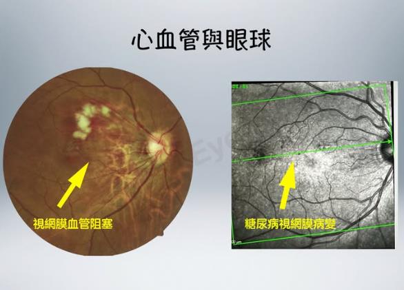 自覺健康卻暗藏危機!男子驗出「視網膜病變」 不知自己已患糖尿病