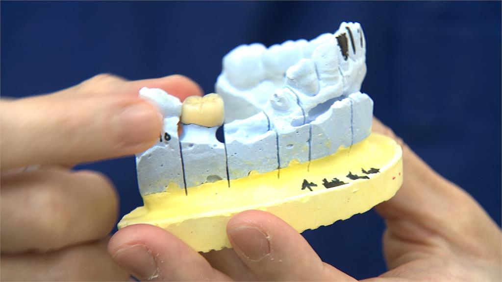 早上看診下午裝假牙！　3D列印假牙一天就能拿到