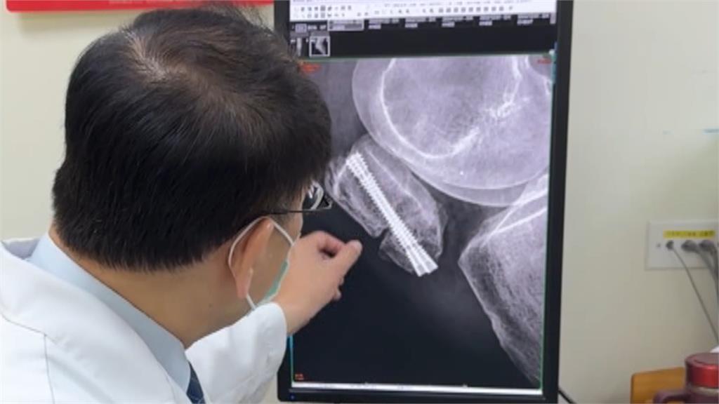 別人追極光她看X光 婦赴挪威摔趴冰上致膝蓋骨折