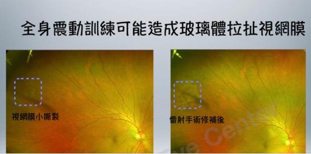 男子用律動機突然眼前一片黑!醫:疑高震動頻律造成「視網膜小撕裂」